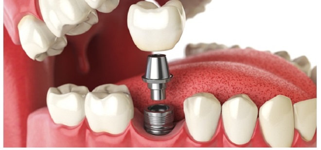 客製化植牙延長使用壽命 小接頭大關鍵