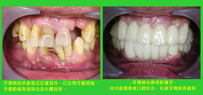 阻斷牙周病病症復發 植牙補齊缺牙加強咬合功能