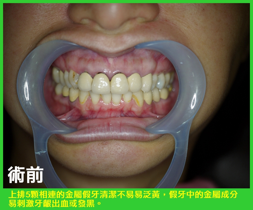 揮別牙齦發黑難清潔窘況 2