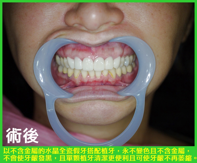 揮別牙齦發黑難清潔窘況 3