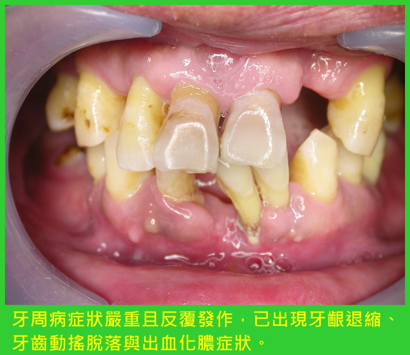 阻斷牙周病病症復發 植牙補齊缺牙加強咬合功能1