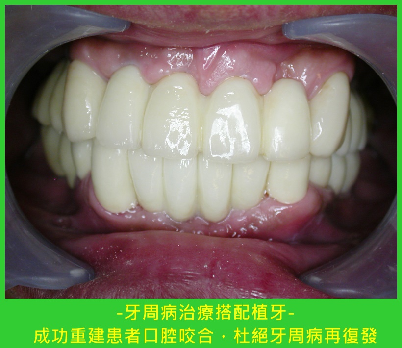 阻斷牙周病病症復發 植牙補齊缺牙加強咬合功能2