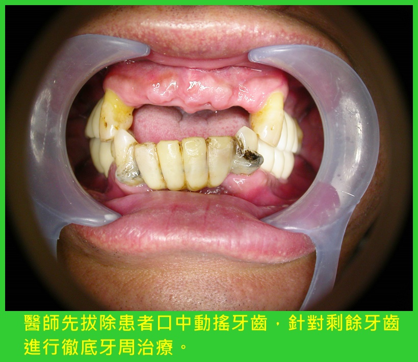 阻斷牙周病病症復發 植牙補齊缺牙加強咬合功能3