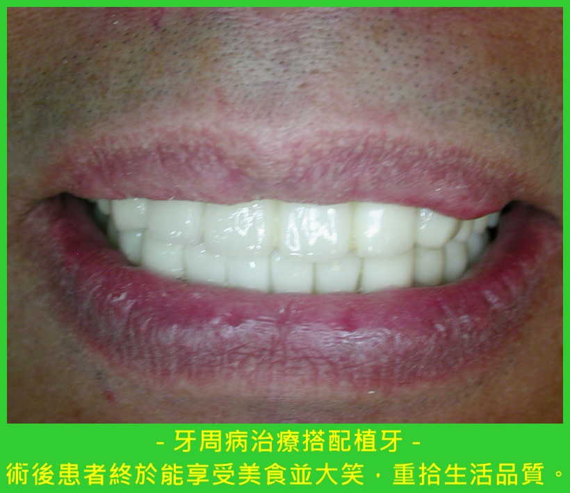 阻斷牙周病病症復發 植牙補齊缺牙加強咬合功能5